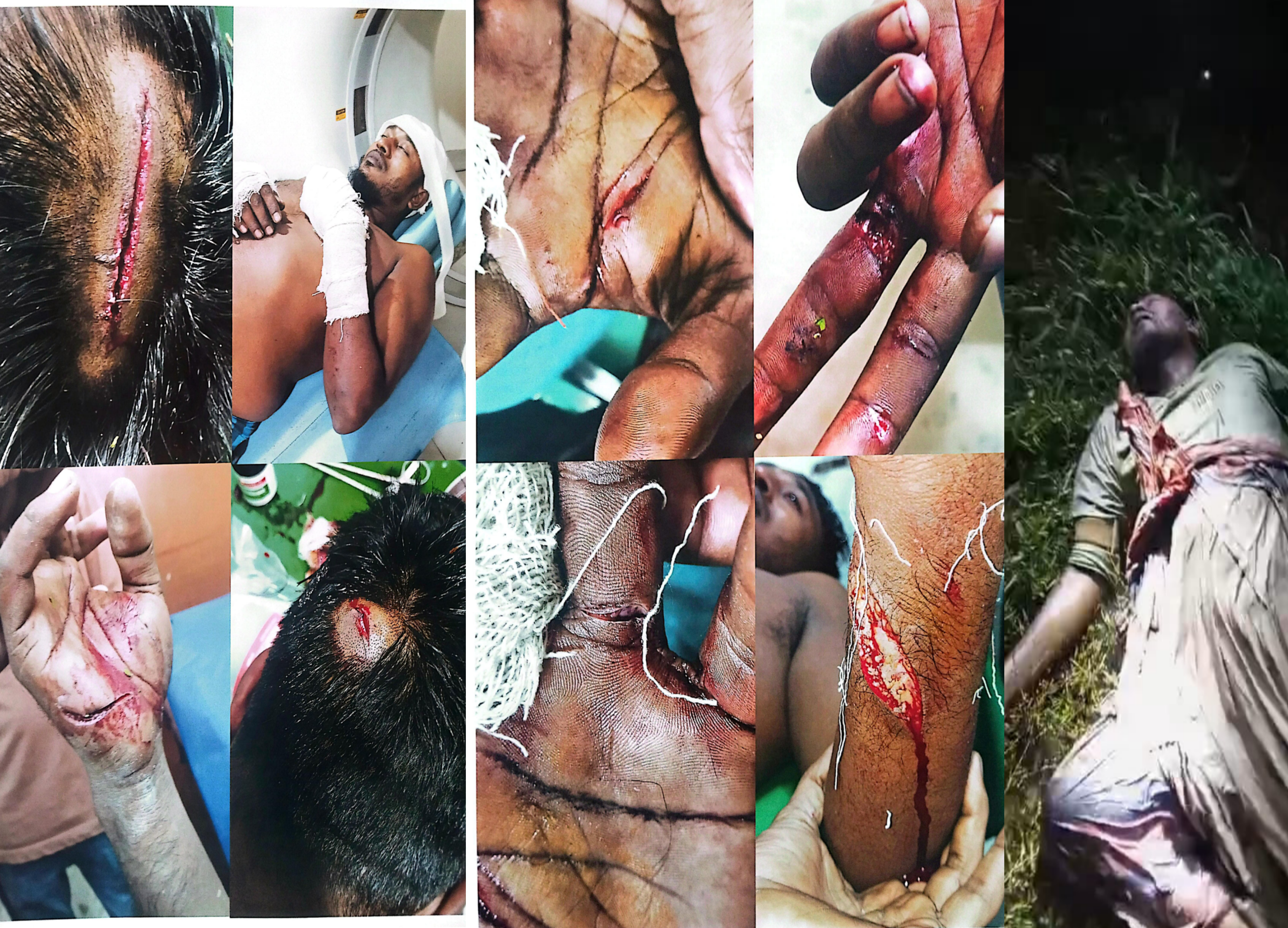 বোরহানউদ্দিনে মিথ্যা মামলার আতঙ্কে গুরুতর আহত রাকিবের পরিবার